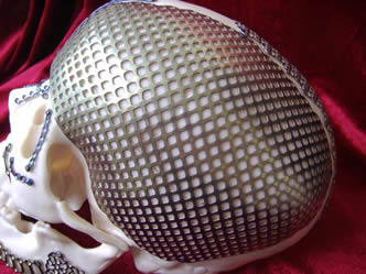 A piece of titanium perforated wire mesh is covering the head model.